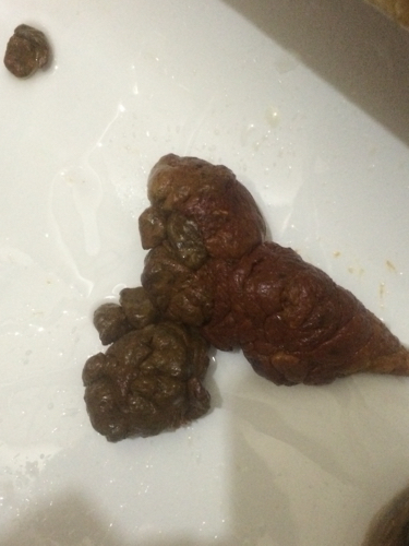 拉屎拉出鮮紅的血不痛，原因分析及應(yīng)對(duì)措施，無痛性鮮紅便血原因解析與應(yīng)對(duì)方案