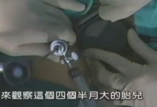 實拍醫(yī)院人流手術全過程，深入了解手術過程與細節(jié)，醫(yī)院人流手術全過程實錄，深度探究手術流程與細節(jié)