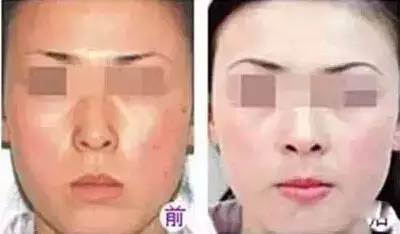 如何在18歲之前讓鼻子變得更挺——實用指南，實用指南，青少年如何讓鼻子更挺——18歲前的鼻子塑形方法