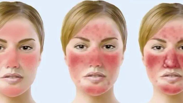 面部痤瘡的癥狀圖片，了解、識別與管理，面部痤瘡，癥狀圖片解析與識別管理指南