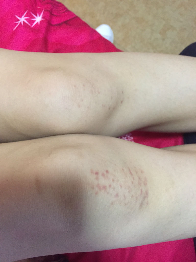 身上長紅色點(diǎn)點(diǎn)是怎么回事，解析癥狀背后的原因與應(yīng)對方法，身上長紅色點(diǎn)點(diǎn)的成因解析及應(yīng)對方法