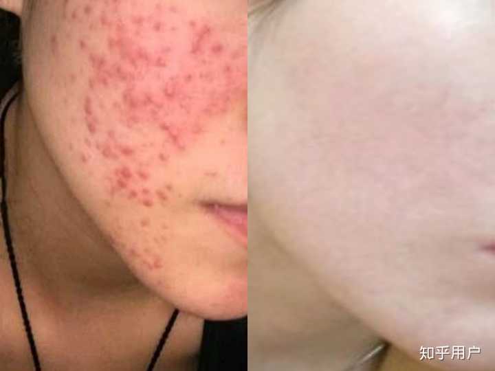 如何有效祛痘印，多種方法助你恢復光潔肌膚，多種方法助你有效祛痘印，恢復光潔肌膚