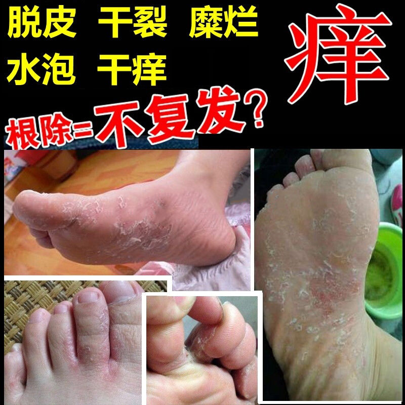 腳癢脫皮起水泡爛腳丫，癥狀解析與藥物治療指南，腳癢脫皮起水泡爛腳丫，癥狀解析及藥物治療指南