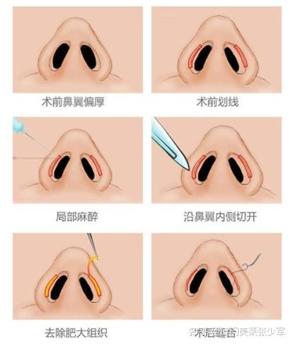 縮小鼻翼的方法，有效改善鼻翼過大的實用指南，縮小鼻翼的有效方法，實用指南助你改善鼻翼過大問題
