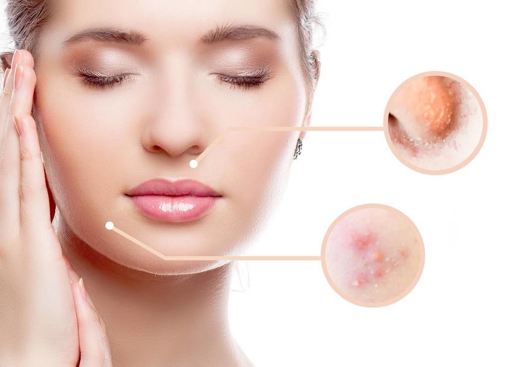 臉上青春痘快速去除的有效方法，臉上青春痘快速去除的有效方法與技巧