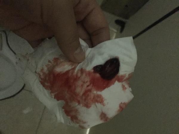 關(guān)于流產(chǎn)，藥流與人流的建議與考量，流產(chǎn)方式選擇，藥流與人工流產(chǎn)的建議與考量