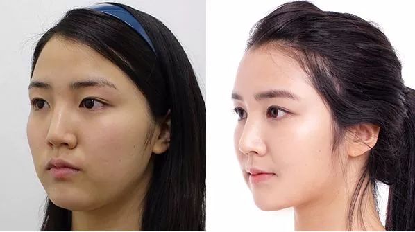 整鼻子老了之后的圖片及其影響，深度探討與理解，鼻子老化后的影響與變化，深度探討及圖片解析