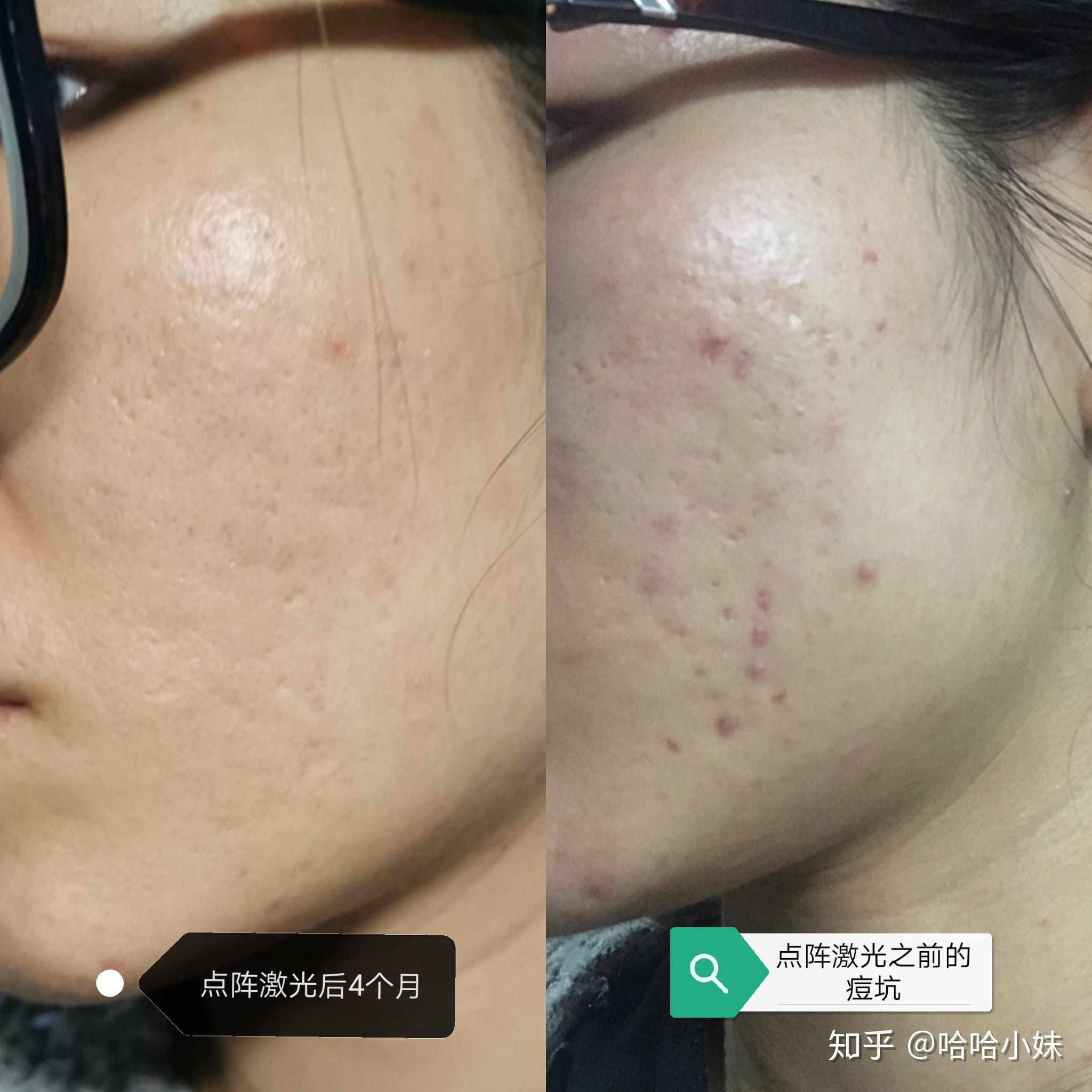 五次點陣激光去痘坑效果深度解析，五次點陣激光去痘坑效果深度解析，專業(yè)解讀與體驗分享