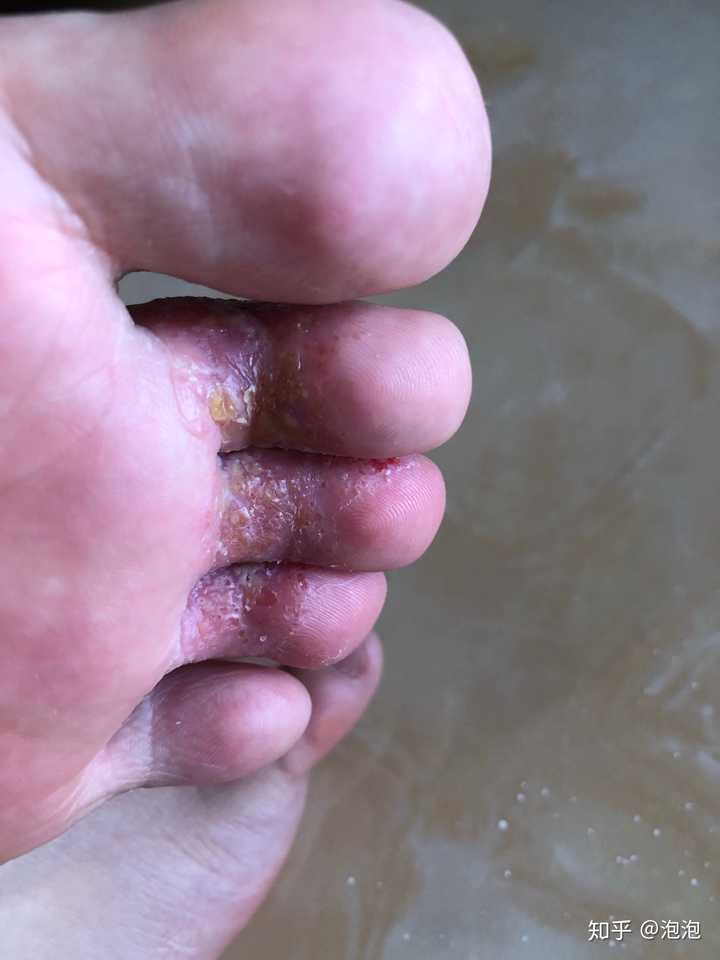 腳氣怎么治——全方位解決方案與預(yù)防策略，全方位解決腳氣問題，治療、預(yù)防策略全解析