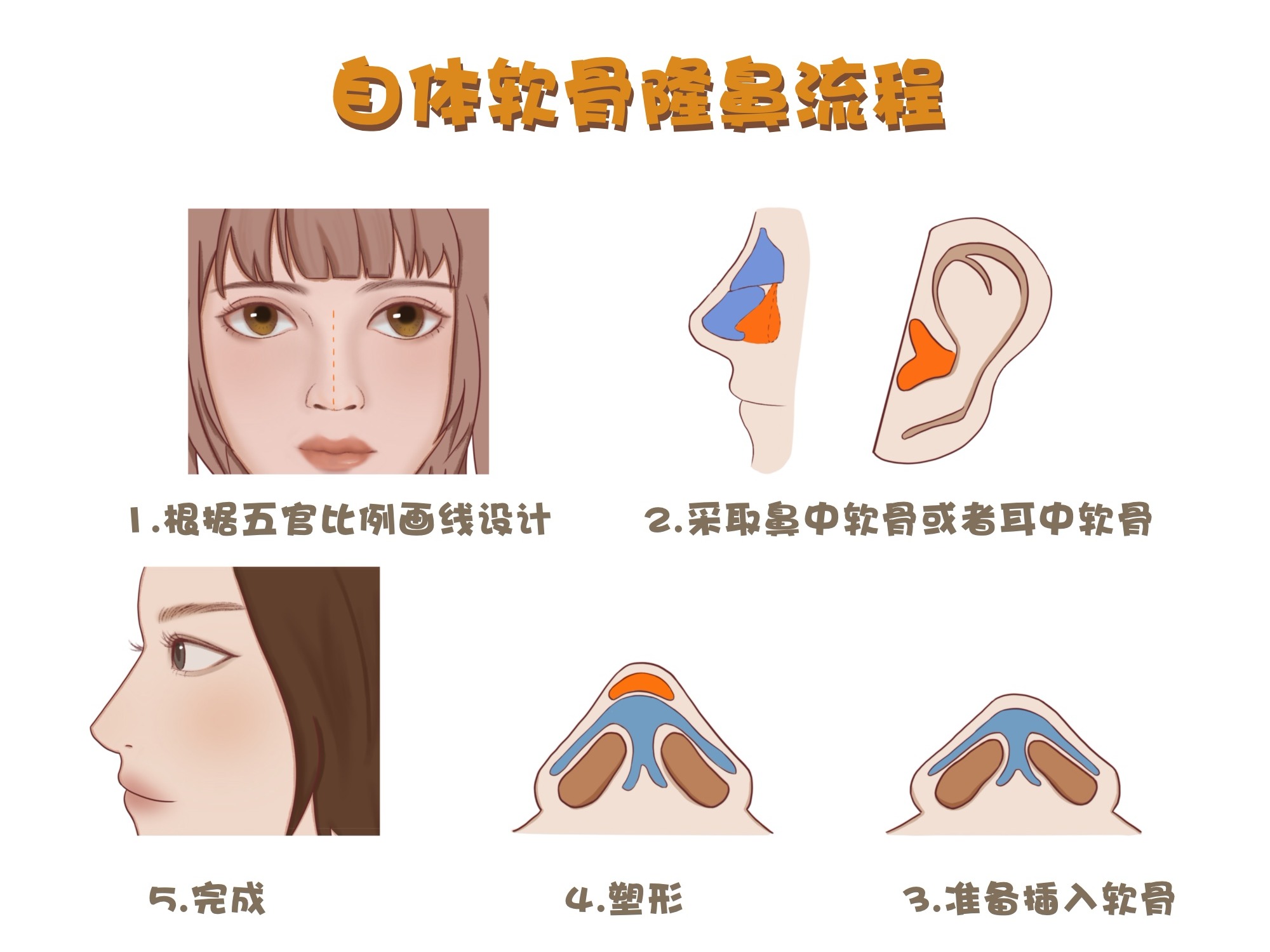 耳軟骨隆鼻的危害有哪些，深入了解與預(yù)防措施，耳軟骨隆鼻的危害及預(yù)防措施，深入了解與探討