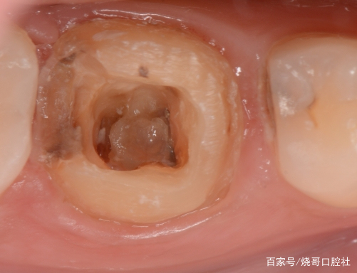 如何判斷牙洞已經(jīng)影響到牙髓？，如何判斷牙洞已影響牙髓，癥狀與診斷方法指南