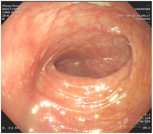 潰瘍性結腸炎能否治愈，解析、理解與展望，潰瘍性結腸炎的治愈解析、展望及理解路徑