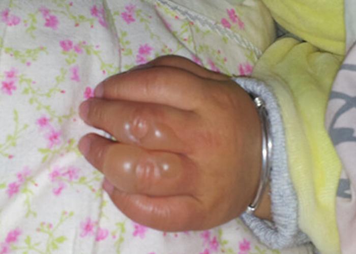 燙傷用什么藥膏最好不留疤——全面解析燙傷藥膏的選擇與使用方法，燙傷藥膏選擇與使用指南，不留疤痕的最佳選擇解析