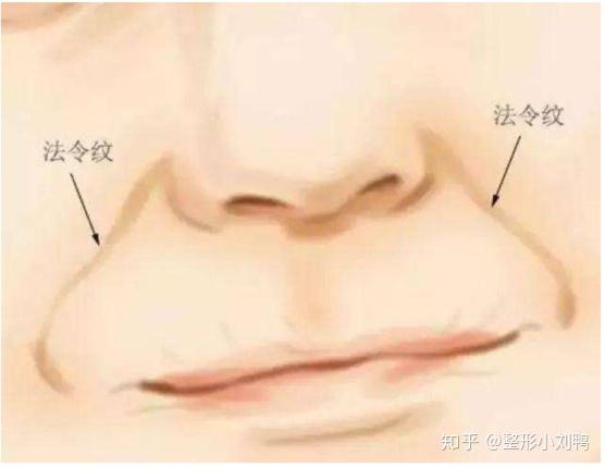 如何有效去除法令紋，最佳方法與建議，法令紋消除術(shù)，最佳方法與建議