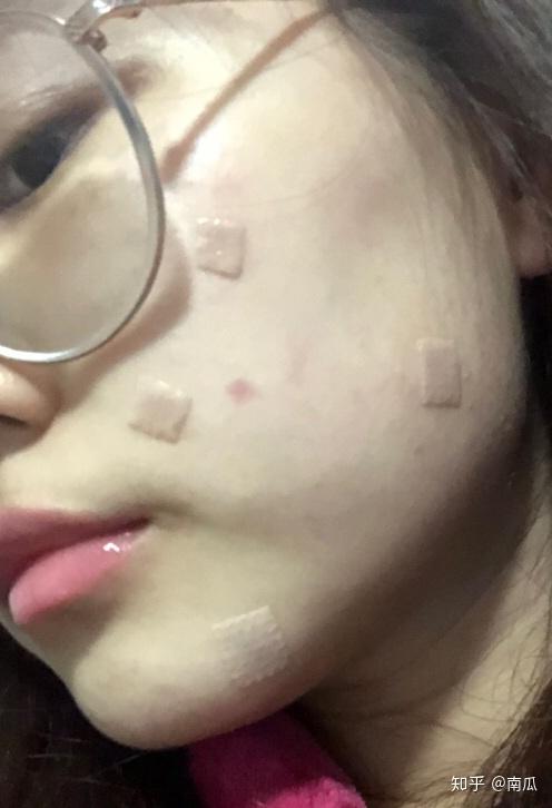 祛痣后十天恢復(fù)圖片，了解恢復(fù)過程，促進健康愈合，祛痣后十天恢復(fù)過程圖片展示，了解愈合進展，助力健康恢復(fù)