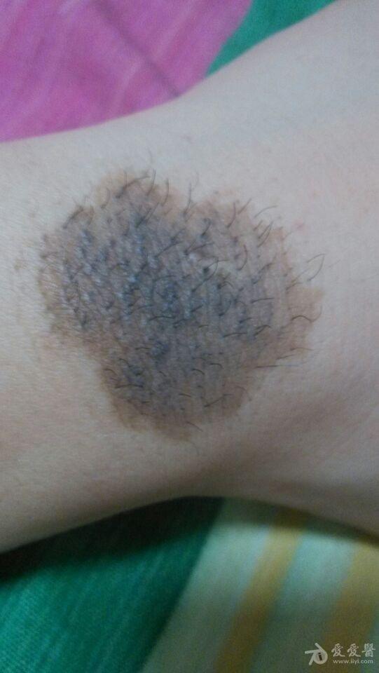 黑色素痣有必要切除嗎？深入了解與決策指南，黑色素痣是否需要切除？全面解析與決策建議