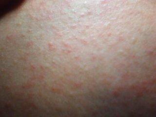 身上紅點(diǎn)不痛不癢圖片，原因解析與應(yīng)對建議，身上紅點(diǎn)無痛無癢，原因解析、圖片參考及應(yīng)對建議