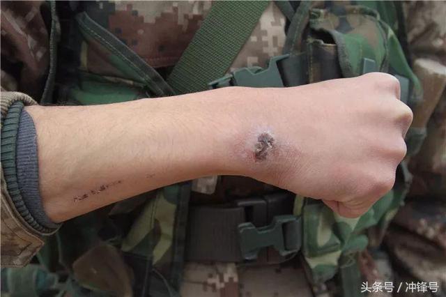 參軍允許的疤圖，解讀身體疤痕與軍事生涯的關(guān)聯(lián)，身體疤痕與軍事生涯，參軍疤痕解讀指南