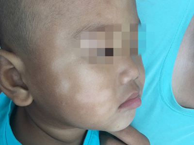 白色糠疹，深入了解與應(yīng)對之道，白色糠疹，深度解析與應(yīng)對策略