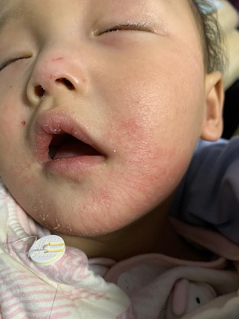 寶寶濕疹圖片，了解、識(shí)別與應(yīng)對(duì)，寶寶濕疹詳解，圖片識(shí)別與應(yīng)對(duì)策略