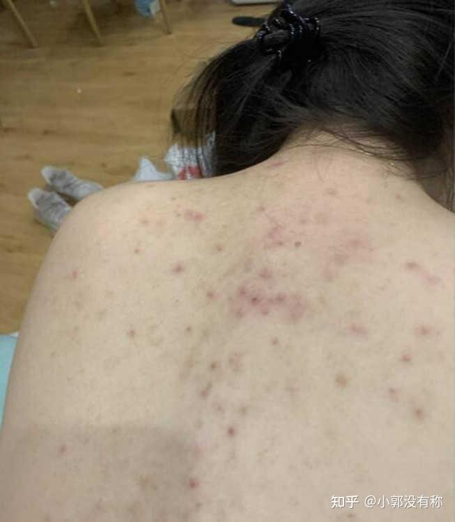 毛囊炎疙瘩消除指南，全面解析毛囊炎疙瘩消除方法，毛囊炎疙瘩消除全面指南，解析最佳消除方法與策略