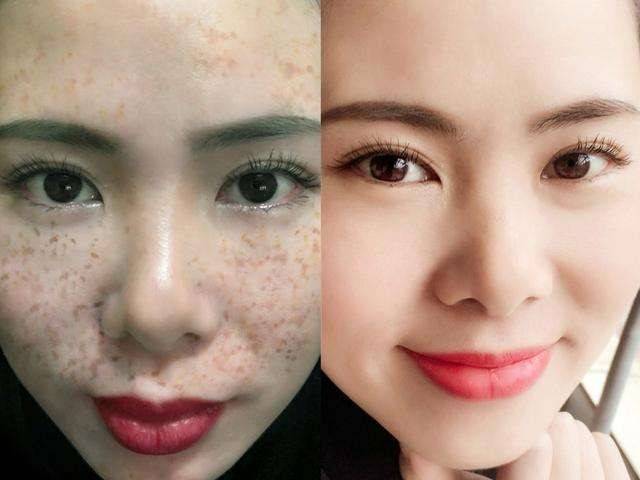 淡斑效果最好的方法，安全與效果的完美結(jié)合，淡斑最佳方法，安全有效，效果卓越