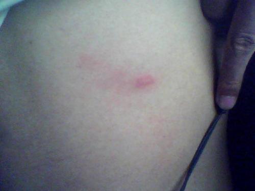 身上起了一塊一塊的像癬一樣紅色——癥狀解析與應(yīng)對(duì)建議，身上起紅色塊狀物如癬，癥狀解析及應(yīng)對(duì)建議