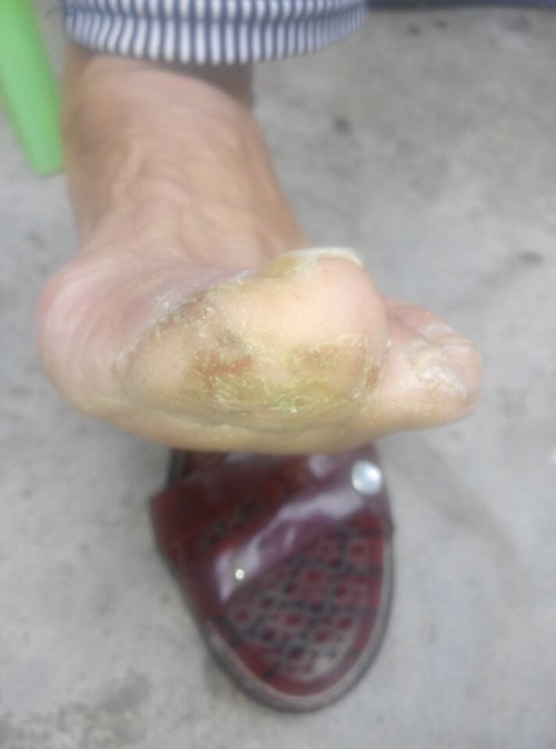 腳脫皮怎么辦？藥物治療推薦與護(hù)理建議，腳脫皮解決方法，藥物治療推薦及護(hù)理建議