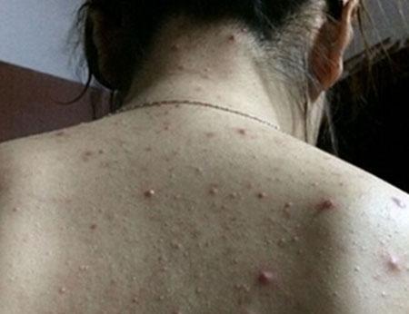 臉上起痤瘡怎么根除，全方位解析痤瘡成因與有效治療方法，全方位解析，如何根除臉部痤瘡，探究成因與有效治療方法