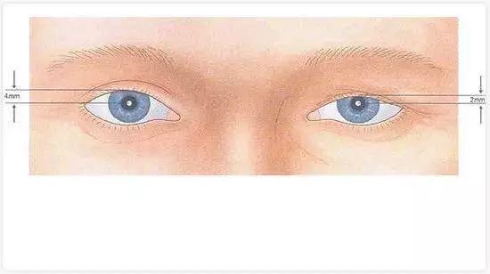 眼瞼下垂手術(shù)費(fèi)用詳解，大約多少錢？，眼瞼下垂手術(shù)費(fèi)用解析，手術(shù)費(fèi)用究竟是多少？