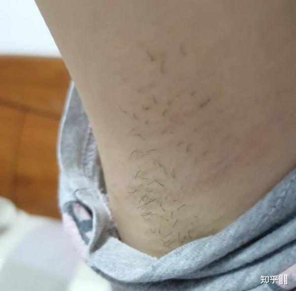 女生是否有必要脫腋毛的探討，女生是否有必要脫腋毛的探討與觀點分歧