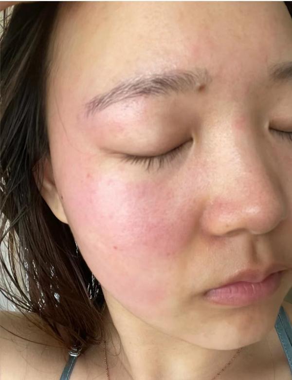 臉部過敏如何迅速消除，全面指南，臉部過敏迅速消除全面指南