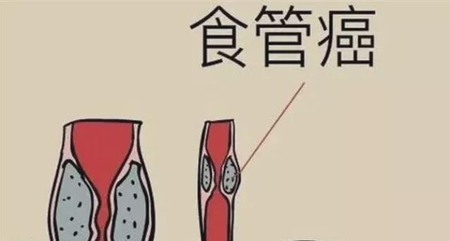 解析食道炎與食道癌的顯著區(qū)別