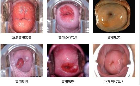 宮頸糜爛自我判斷方法及其重要性，宮頸糜爛的自我檢測(cè)方法與判斷的重要性