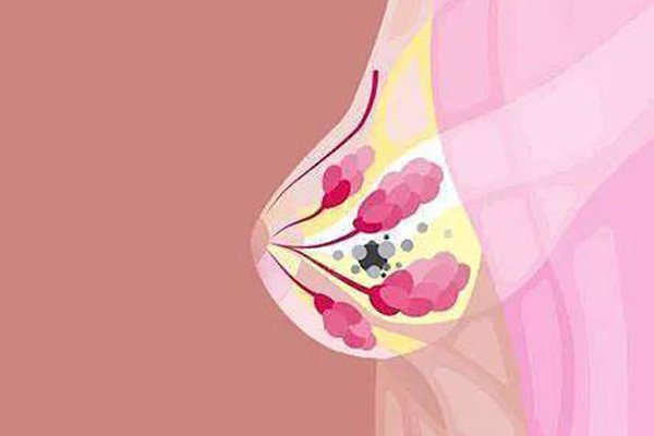 乳腺結節(jié)三類飲食禁忌，健康生活的關鍵，乳腺結節(jié)三類飲食禁忌，守護乳房健康的關鍵之道