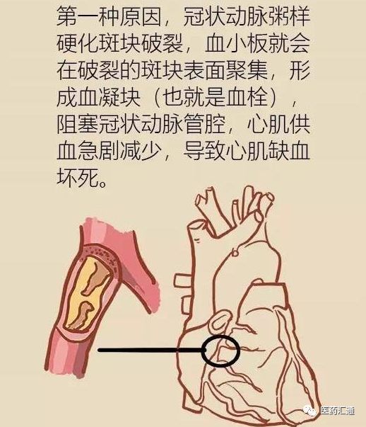 心肌梗塞的原因及其影響，深度解析，心肌梗塞的深度解析，原因與影響探討