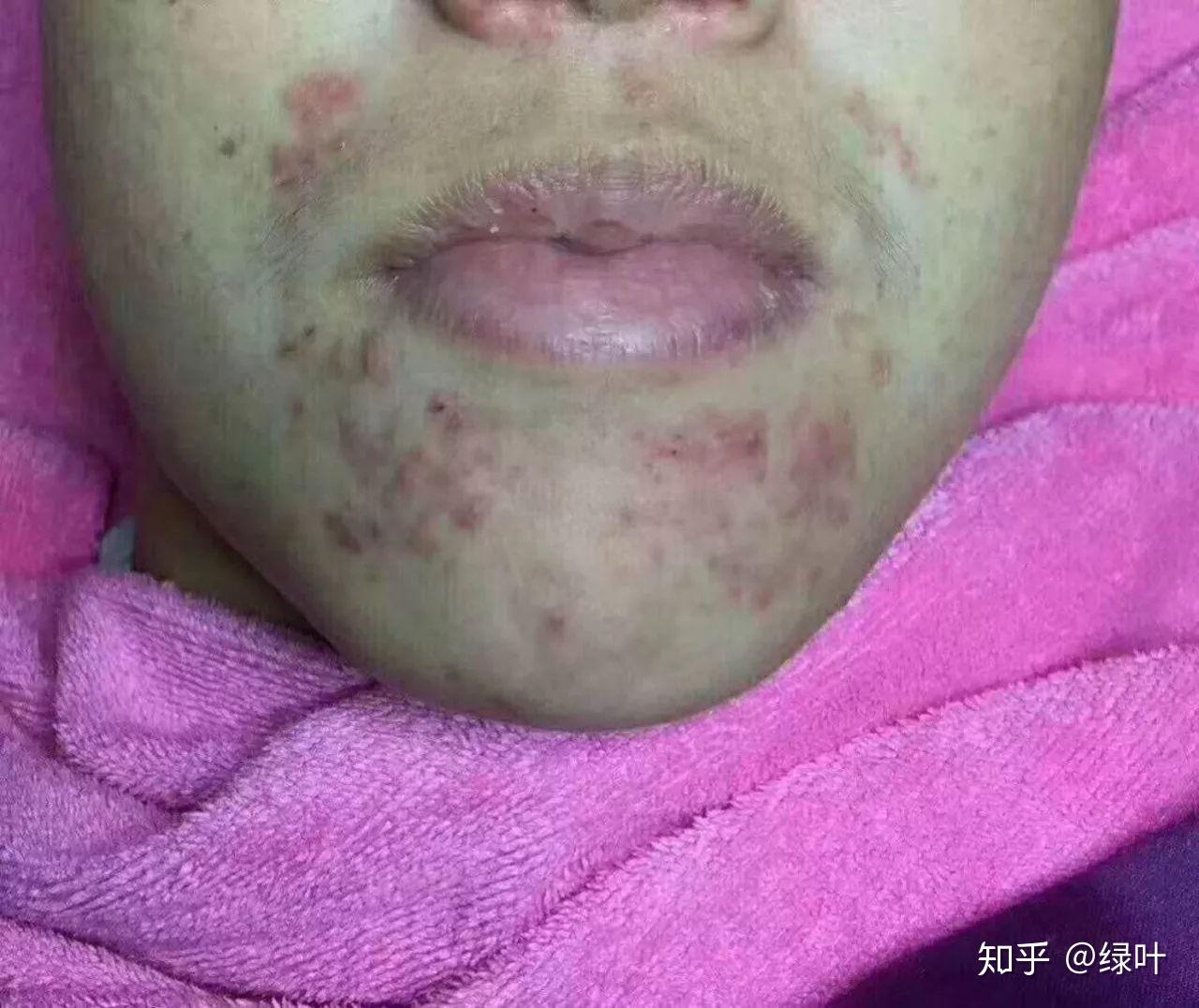 下巴周?chē)磸?fù)長(zhǎng)痘痘的原因及解決方法，下巴周?chē)磸?fù)長(zhǎng)痘成因與解決策略