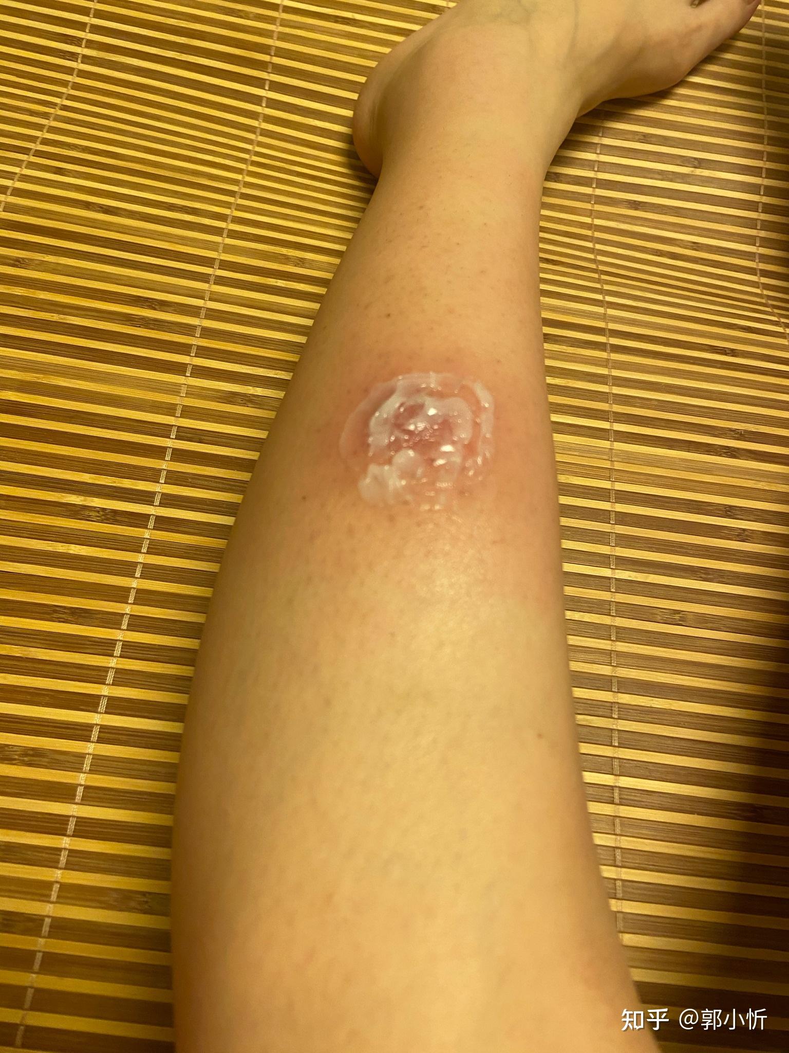 火癤子成熟的圖片，了解、識別與治療，火癤子，成熟圖片、識別方法與治療詳解