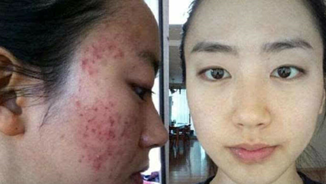 怎樣去痘印效果最好的方法，揭秘最佳去痘印方法，告別臉部瑕疵！