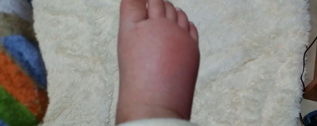 腳腫是什么原因引起的，全面解析腳部腫脹的多元因素，腳部腫脹的多元因素全面解析，原因與應(yīng)對方法