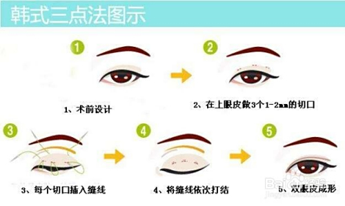 割雙眼皮手術(shù)費用詳解，價格因素與選擇重要性，雙眼皮手術(shù)費用詳解，價格因素與選擇的重要性