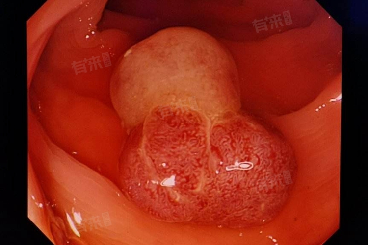 結(jié)腸腫瘤患者能活多久，全面解析與希望之光，結(jié)腸腫瘤患者生存期限解析，全面探討與希望之光